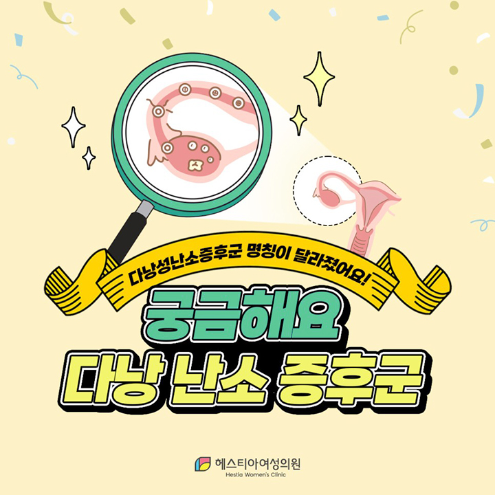 다낭 난소 증후군