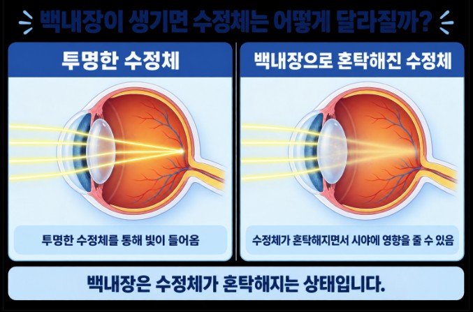투명한 수정체와 백내장으로 혼탁해진 수정체의 차이