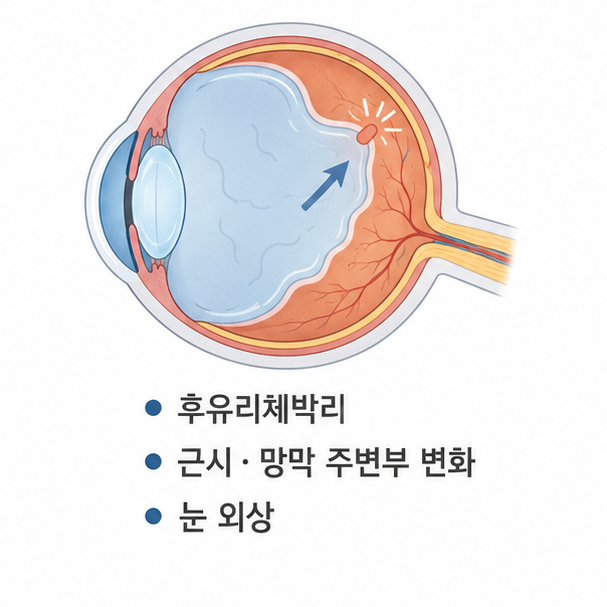 후유리체박리와 근시&middot;망막 주변부 변화&middot;눈 외상이 망막에 영향을 주는 모습