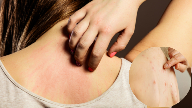 명절 비상 상비약 목록 항히스타민제