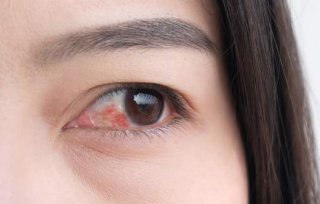 결막염 증상