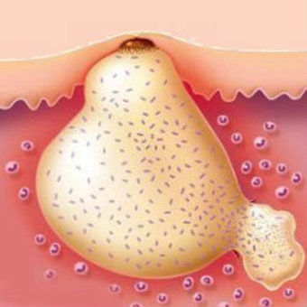화농성 한선염 치료 수술 병원
