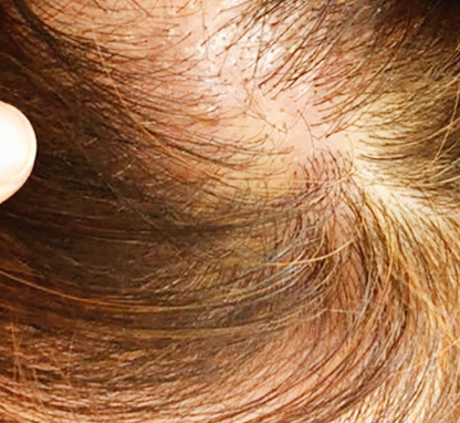 지루성 두피염 완벽 가이드: 증상&amp;#44; 원인&amp;#44; 치료&amp;#44; 관리&amp;#44; 샴푸&amp;#44; 후기까지!