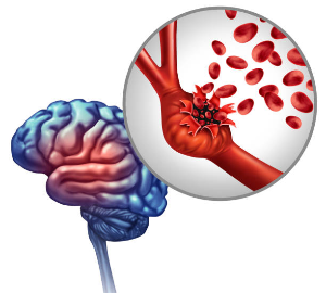 내 머릿속에 시한폭탄이 있습니다. 뇌동맥류의 원인과 주요 증상, 관리방법에 대해 알아보자.