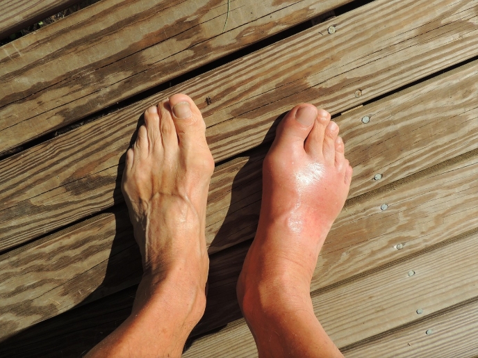 통풍으로 발이 부어있는 사진