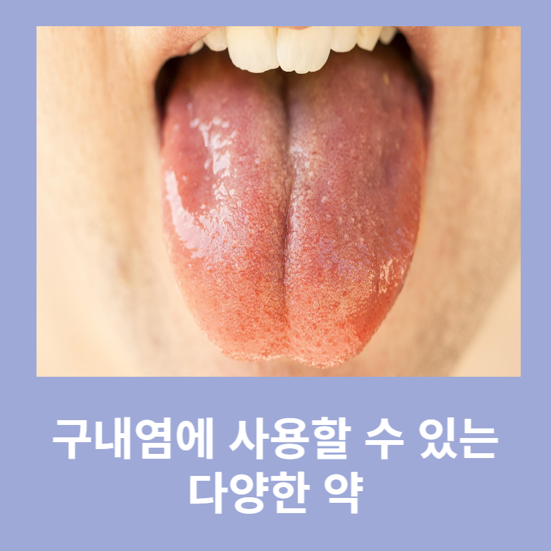 구내염 약