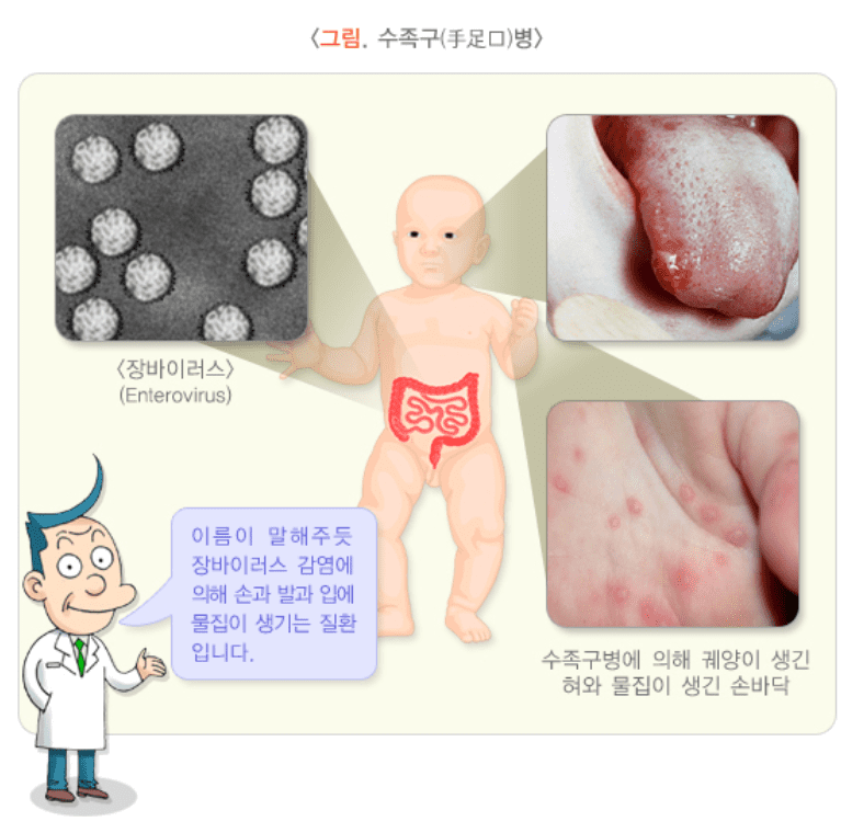 수족구는 장바이러스의 일종인 설명