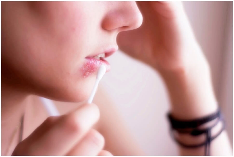 대상포진 초기증상