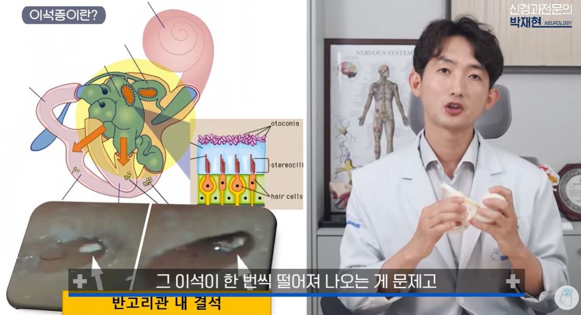 이석증 자가치료
