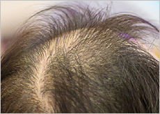 모바렌 가격, 성분, 부작용, 싸게파는곳