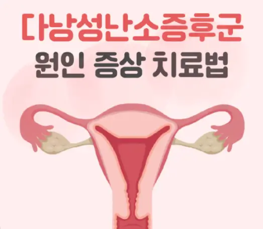 다낭성 난소증후군