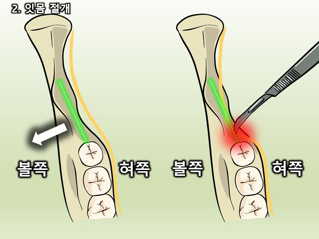 사랑니 발치 과정과 통증, 신경 손상에 대한 모든 것