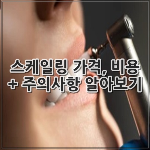 스케일링 가격, 비용 + 주의사항 알아보기