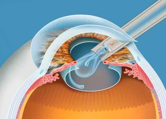 렌즈삽입술 적합한 사람 교정하는 방법 회복관리