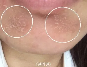 얼굴 버짐 증상 없애는 실전 방법 5가지 및 관리요령_17