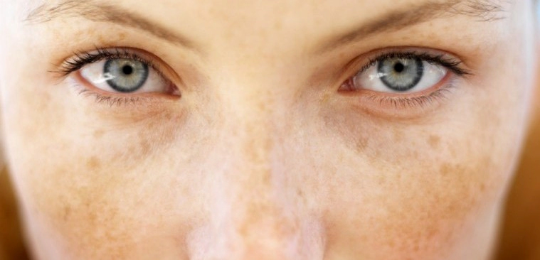 기미 없애는 방법