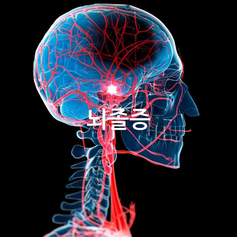 귀주름과치매와뇌졸중