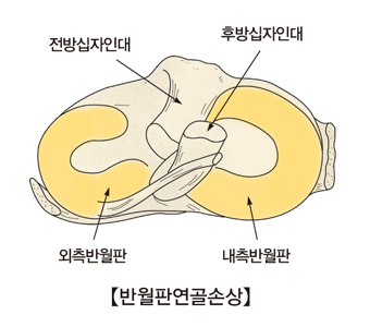 반월판 연골손상 사진