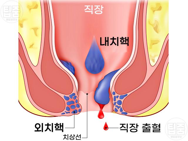 만성변비 합병증 치질
