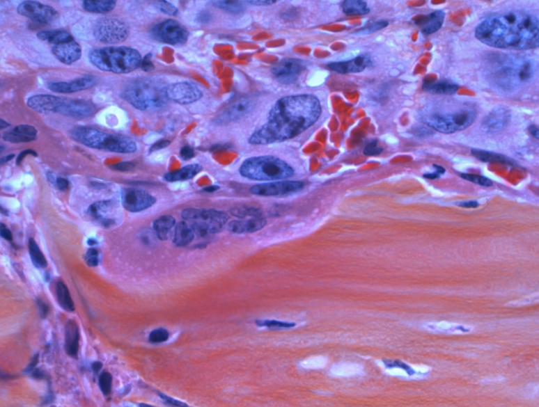 췌장암 초기증상 관리법 총정리