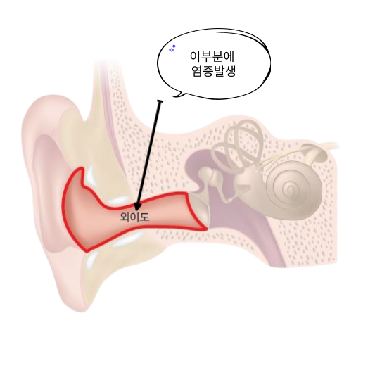 여름철 귀 질환: 외이도염과 외상성 고막파열