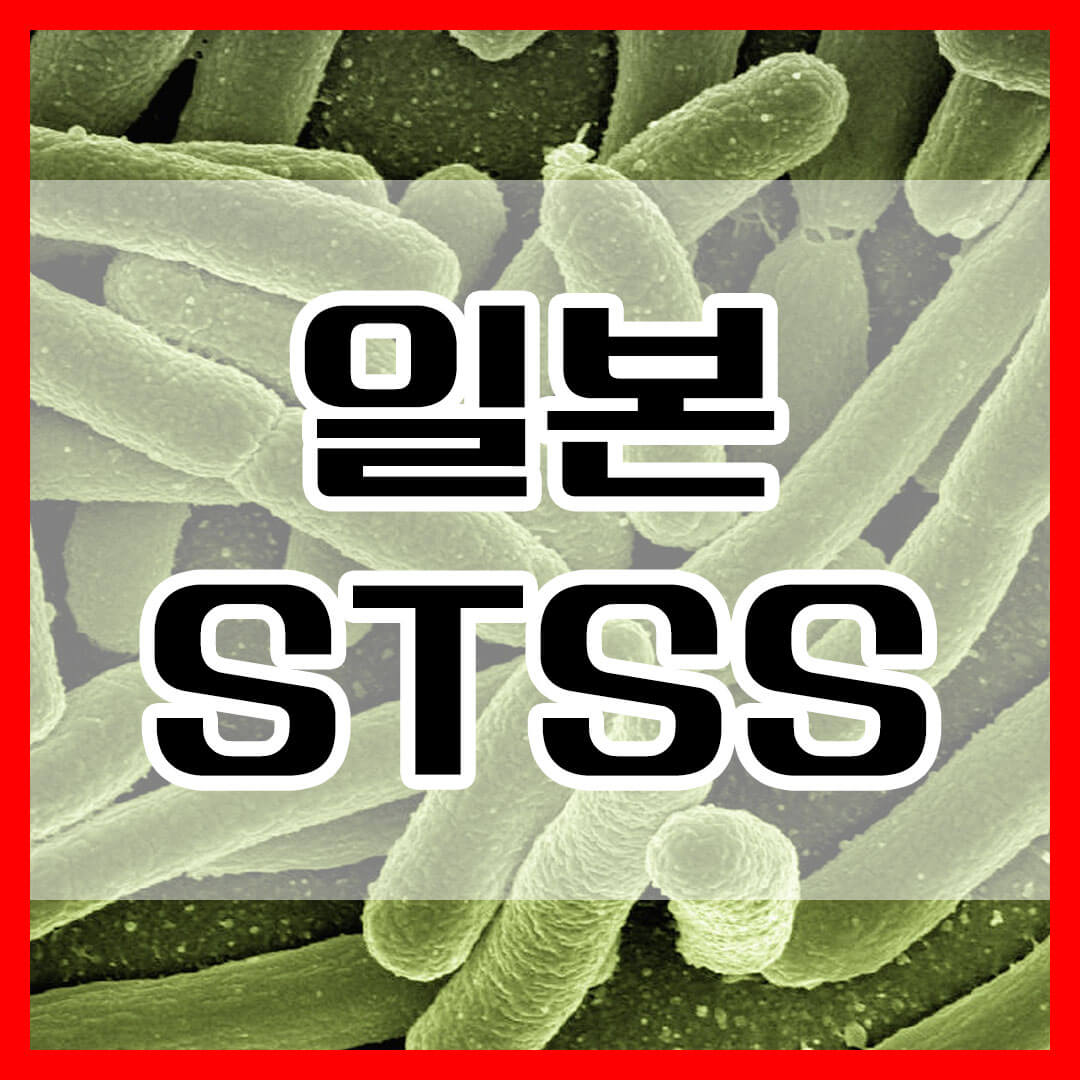 일본 stss