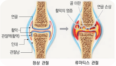 펠루비정-부작용-펠루비정-효능