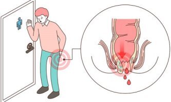 치센