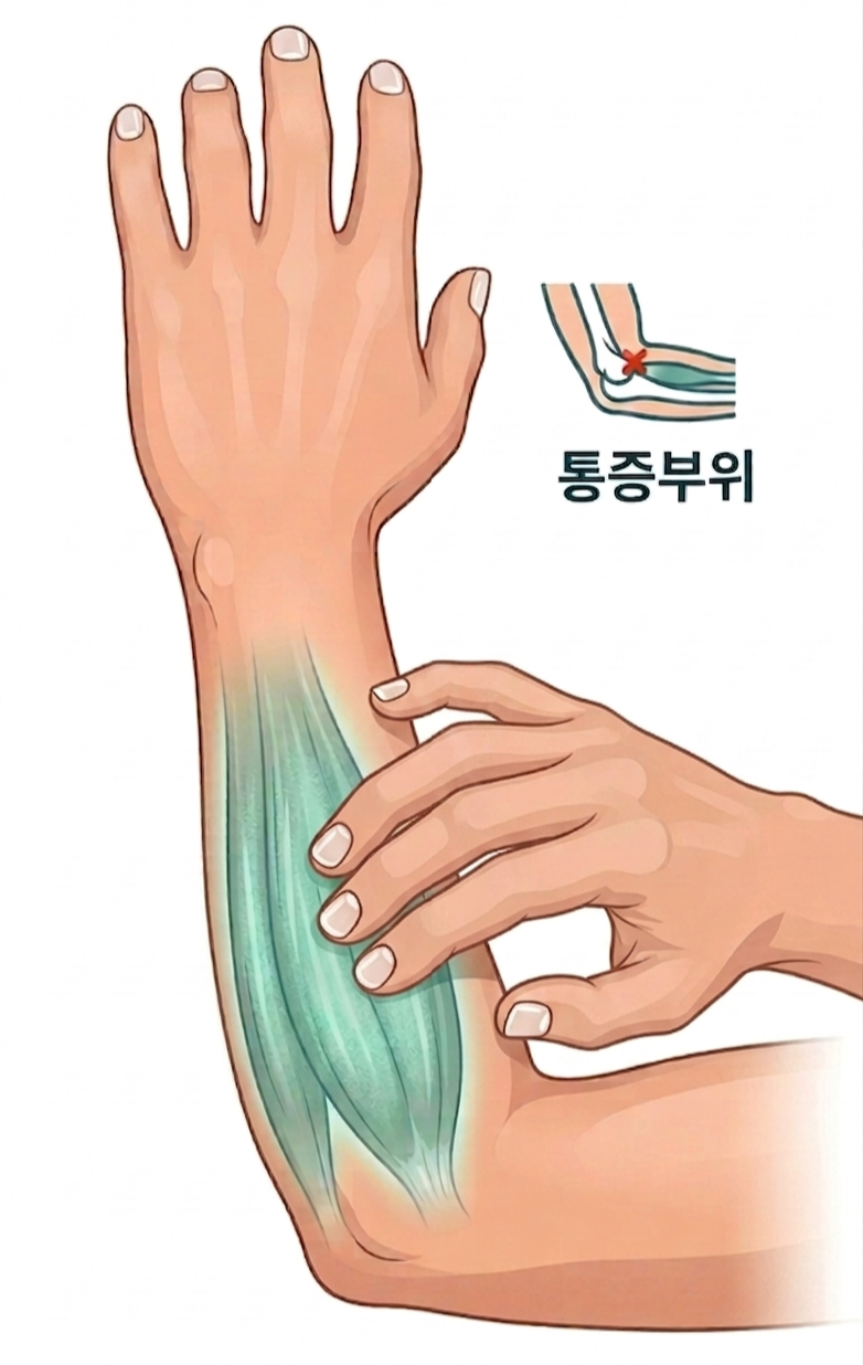팔꿈치 외측 통증 완화 마사지 시 올바른 근육 위치 찾는 법