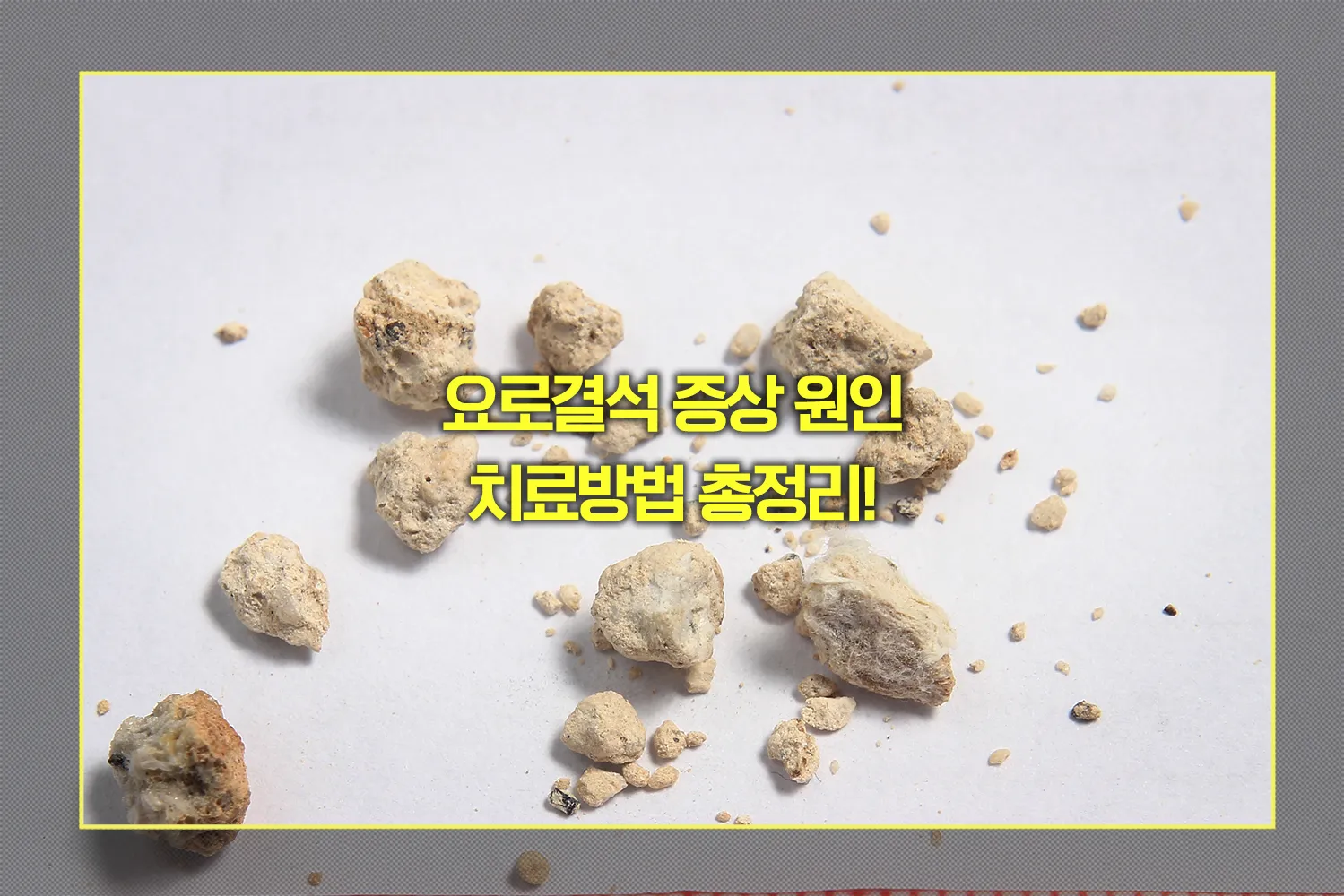 요로결석 증상 원인 치료방법