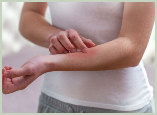 피부묘기증 예방법