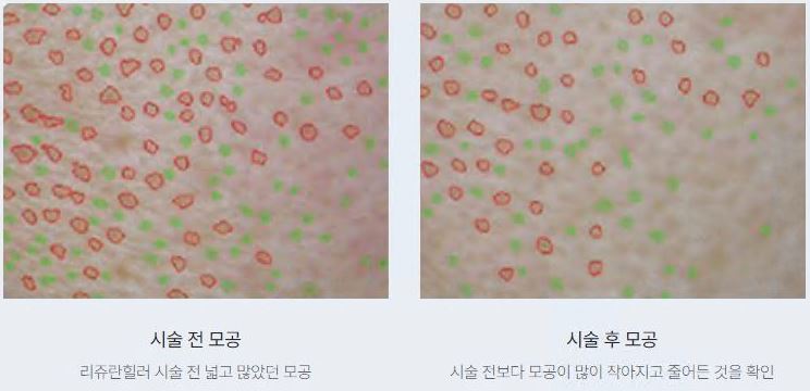 리쥬란 효과