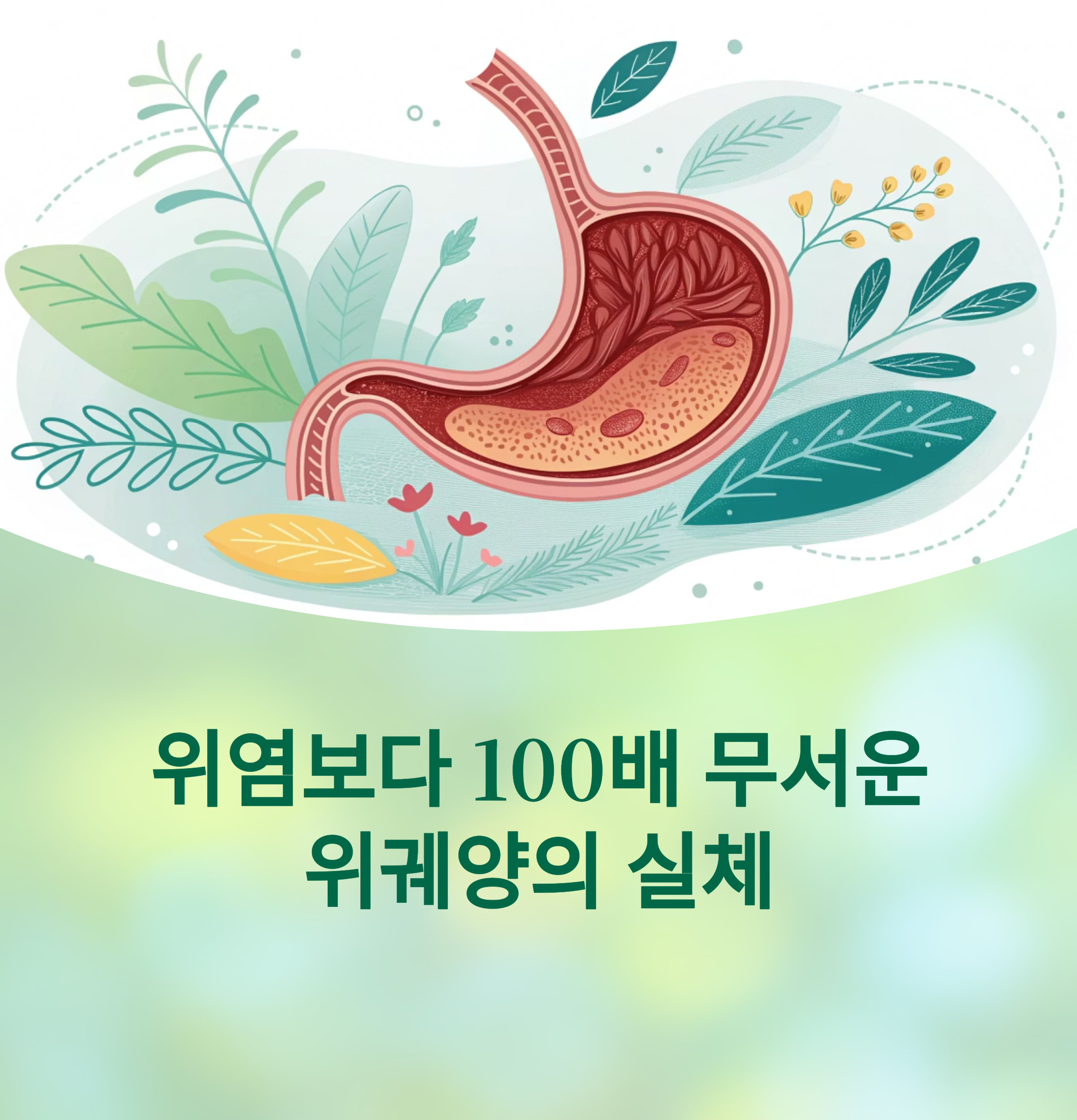 위염보다 100배 무서운 위궤양의 실체에 대한 이미지