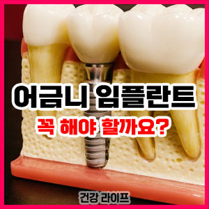 어금니 임플란트