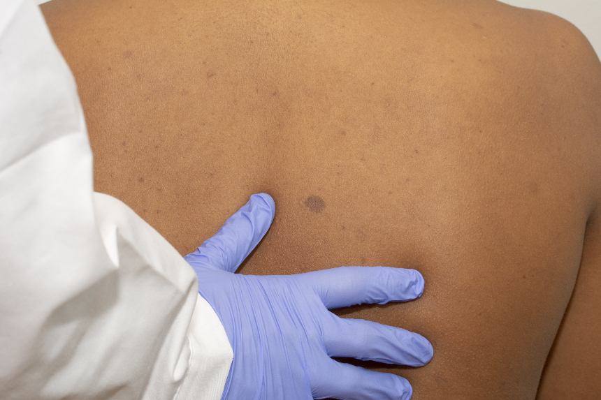 신경섬유종 초기 증상, 혹시 나도? 놓치면 안 되는 신호