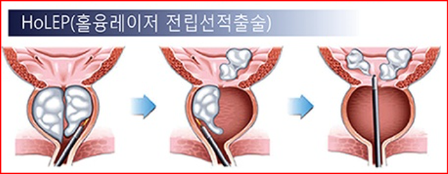 alt="홀뮴 레이저 전립선 절제술 (HoLEP)"