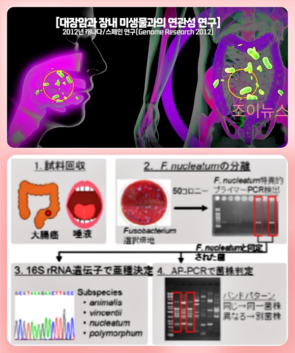 대장암과 구강 세균의 관계에 대한 여러 자료들