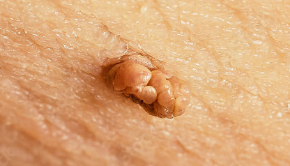 쥐젖
쥐젖 제거
쥐젖 원인
쥐젖 연고
쥐젖 패치
쥐젖 사과식초
피부 섬유종
쥐젖 치료
조합 키워드
쥐젖 생기는 이유
쥐젖 제거 방법
쥐젖 제거 비용
쥐젖 자연 제거
쥐젖 사과식초 효과
쥐젖 제거 연고 추천
쥐젖 냉동 치료
쥐젖 레이저 제거
쥐젖 패치 사용법
쥐젖 제거 후 관리법