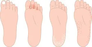 무좀 원인과 증상