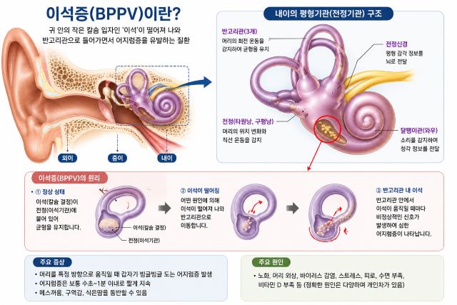귀 안쪽 이석이 반고리관으로 이동해 어지럼증을 일으키는 원리