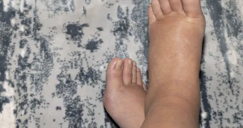 하지 정맥류 증상 15