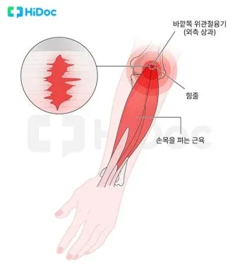 팔꿈치 통증 원인 6가지증상운동법예방법치료법까지_6