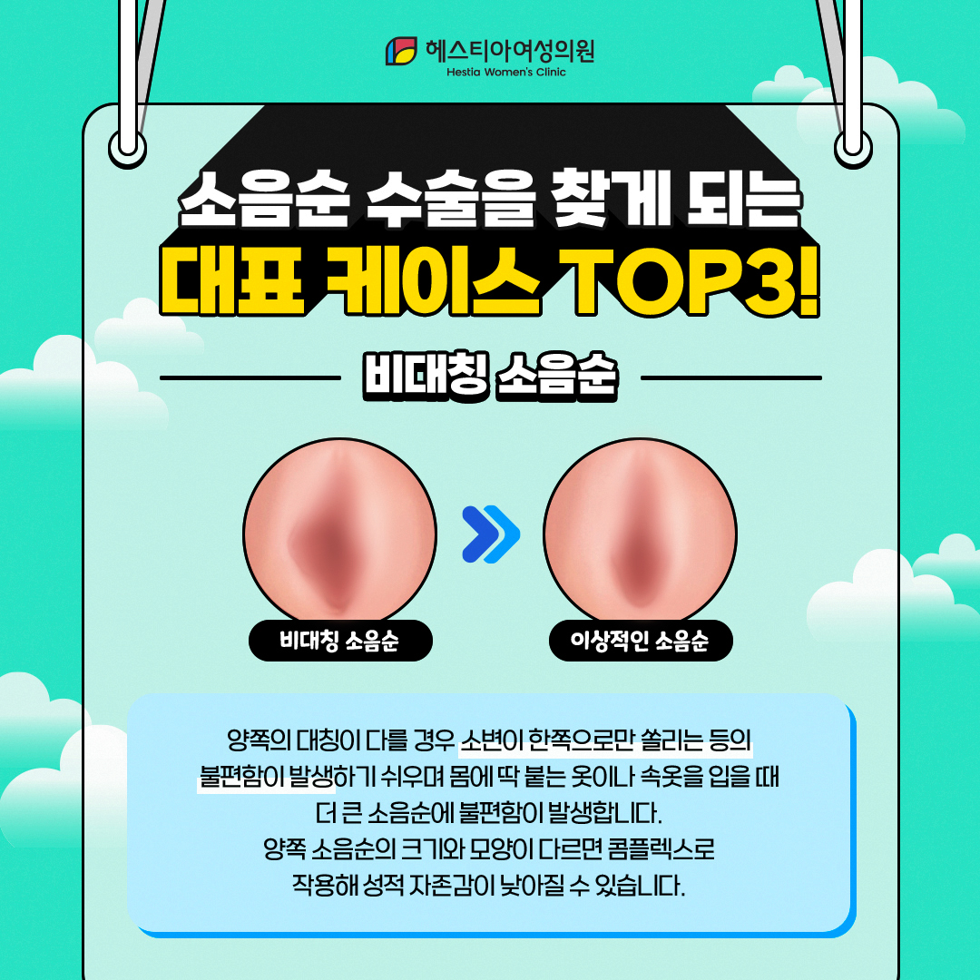 비대칭소음순