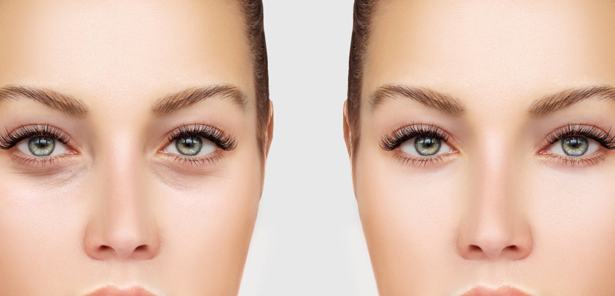 하안검 수술방법