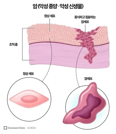 암 초기증상부터 원인·조기진단까지