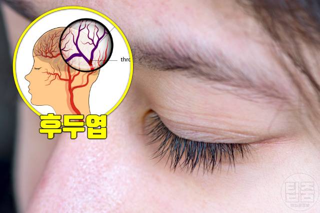 뇌졸중 전조증상 체크리스트 눈 뇌졸중 전조증상 테스트