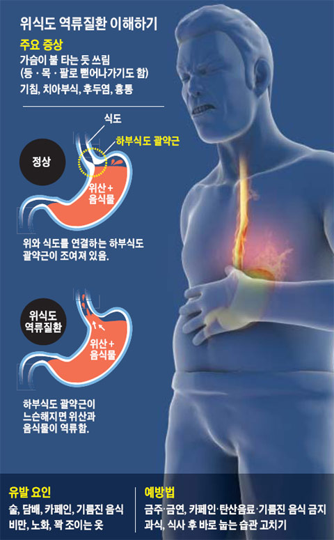 역류성 식도염 가슴 통증&amp;#44; 심장 문제와 헷갈리는 이유