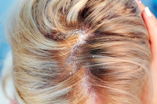 지루성 두피염(Seborrheic Dermatitis): 개요와 치료법
