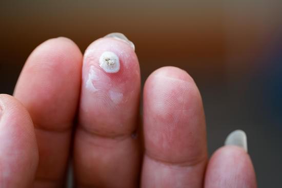 사마귀(Warts): 원인, 증상, 치료 및 예방