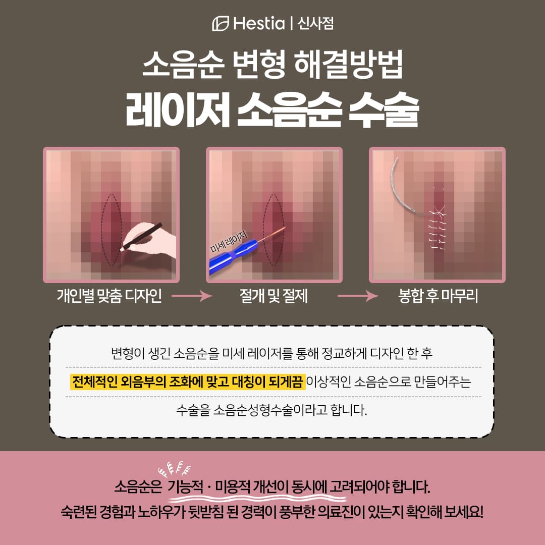 소음순교정술, 어떻게 진행될까요?